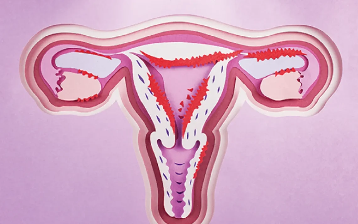 cancer uterino;